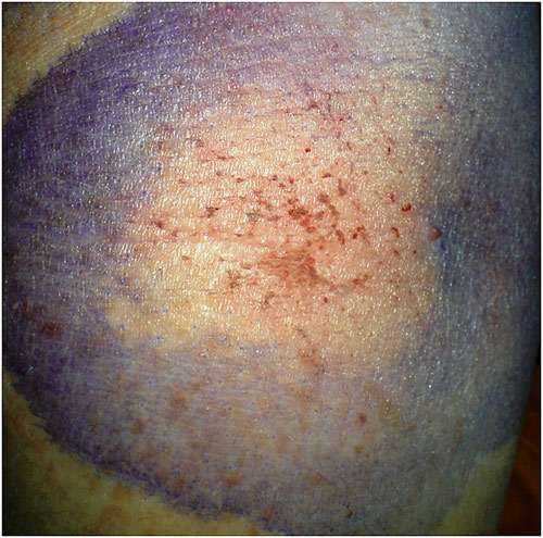 Morgellons disease photo